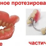 Полировка зубных протезов